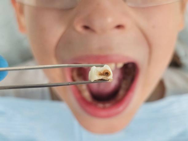 Best Emergency Dental Care for Broken or Chipped Teeth in Rocky Mount, VA
